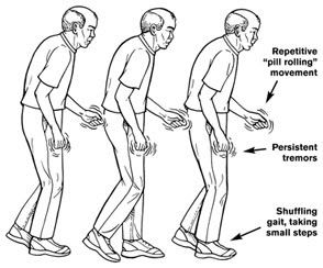 parkinsons.jpg