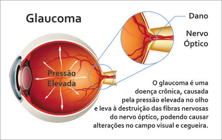 univi_glaucoma.jpg