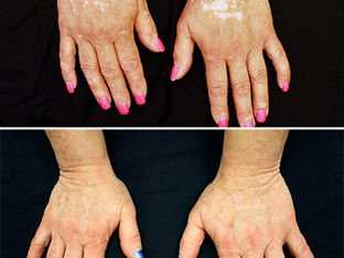 Cientistas revertem vitiligo em paciente com droga para artrite