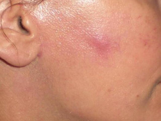 A Really Bad Infection