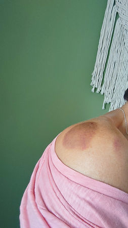 After a bit of 'cupping'