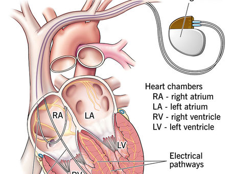 It's Aortic Disease Awareness Month - What is Arrhythmia?
