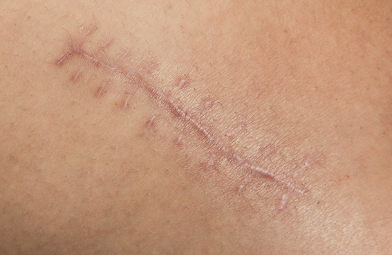 Close-up of a fully healed surgical scar