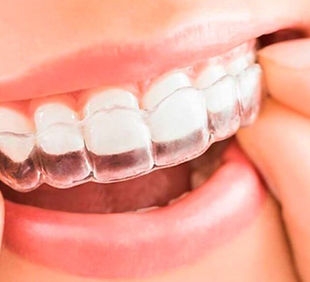 invisialign-1024x586.jpg