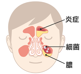 希望ヶ丘耳鼻咽喉科 副鼻腔炎(蓄膿症)