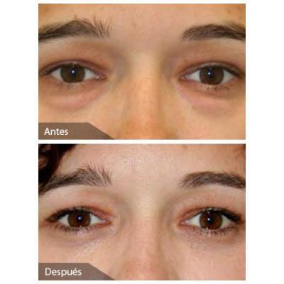 blefaroplastia-4.jpg