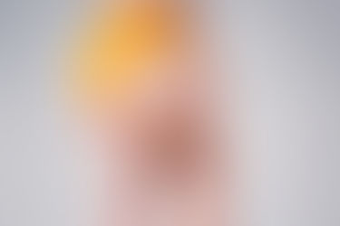 Липедема: когато „целулитът“ всъщност е болест