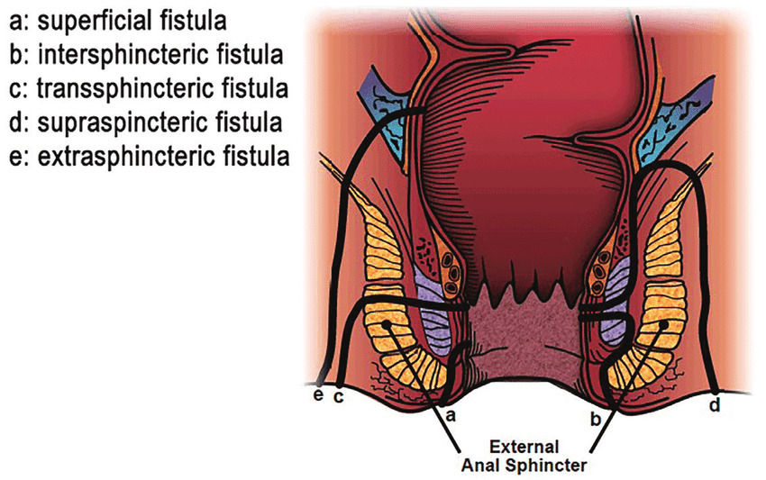Diagram illustrating five types of anal fistulas, labeled a-e, with arrows pointing to different regions of the anal sphincter.