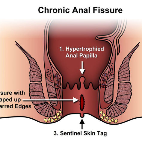 Understanding the Causes of Anal Fissures