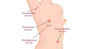Can I Breastfeed After Having Breast Surgery?