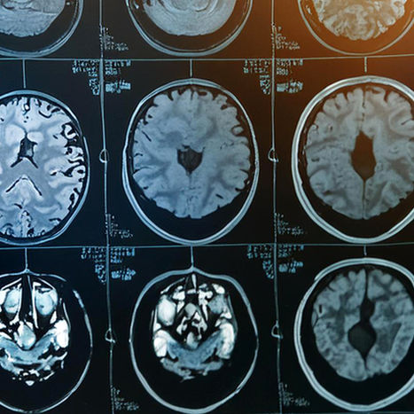 WOMAN DONATED HER BRAIN TO SCIENCE—ALZHEIMER'S EXPERTS SHOCKED BY DISCOVERY