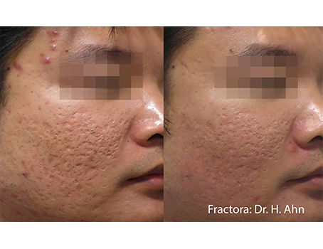 AHN_Fractora_2a_28Male4tx_RS_popup.jpg