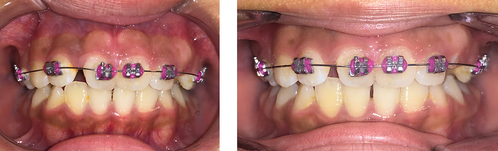 La Técnica 4 × 2: Un Enfoque Temprano para una Sonrisa Perfecta