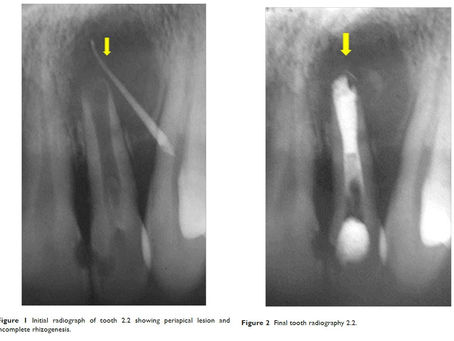 Incomplete rhizogenesis and necrosis treated with PBS® HP cement synthetic barrier