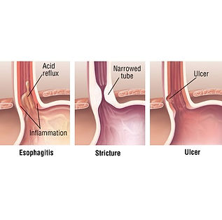 GERD Atlanta treatment