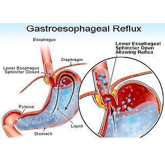 acid reflux GERD gastroesophageal reflux treatment atlanta