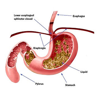 GERD heartburn atlanta endoscopy center.