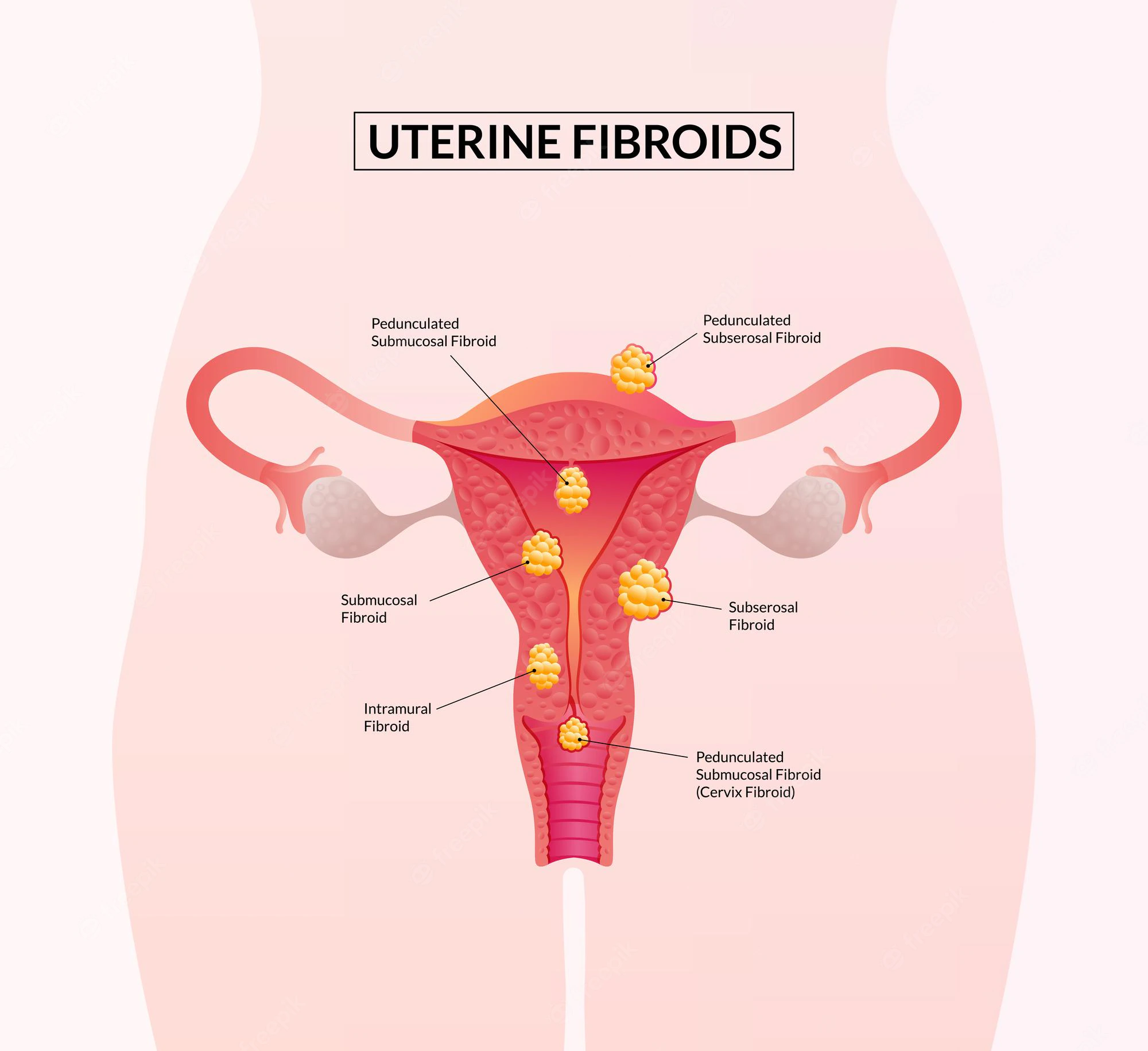tipos-de-miomas-uterinos-doencas-do-sistema-reprodutor-feminino_476141-744.webp