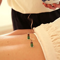 moxibustion