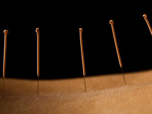Acupuncture Low Back up close