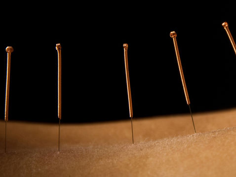 Acupuncture Low Back up close