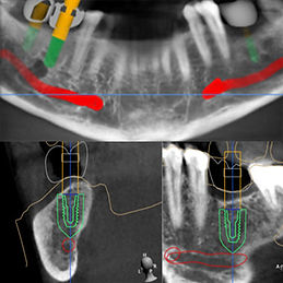 implant