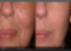 Laser Scar Removal - Electrik Image