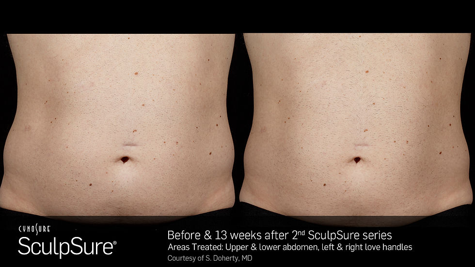 SculpSureBefore&After_SidebySide_Male5