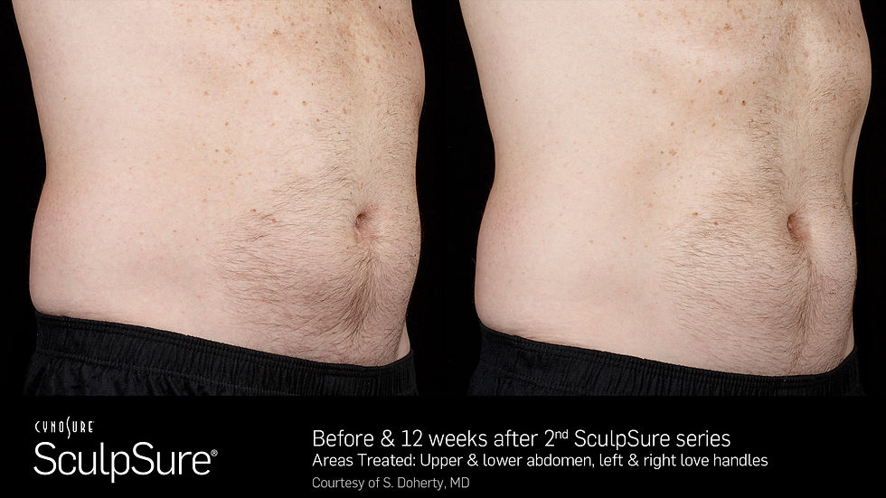 SculpSureBefore&After_SidebySide_Male9