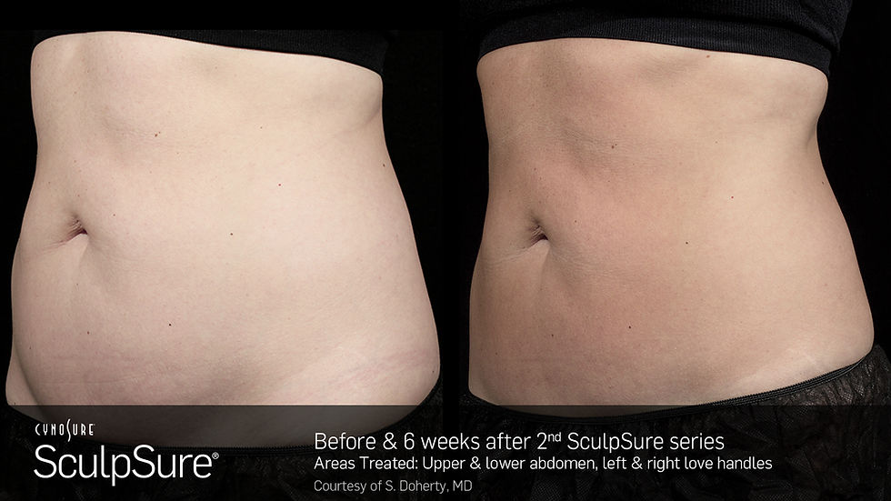 SculpSureBefore&After_SidebySide_Female2
