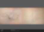 Laser Hair Removal - Toledo & Detroi