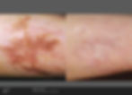 Laser Scar Removal - Electrik Image