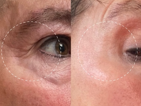 The Amazing Louise Walsh Plasma Pen For Eye Lifting