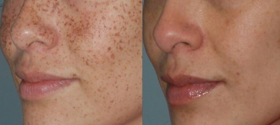 DyeVL results for hyperpigmentation