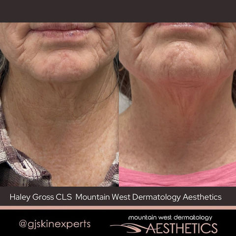 Radio Frequency Microneedling by Haley Gross, CLS, LE