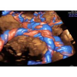 Umbilical Cord with HD-Flow.png