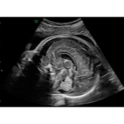 27-week corpus callosum and cerebellar vermis.png