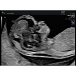 Nuchal Translucency