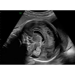 Fetal brain with C2-9 probe and HDRes
