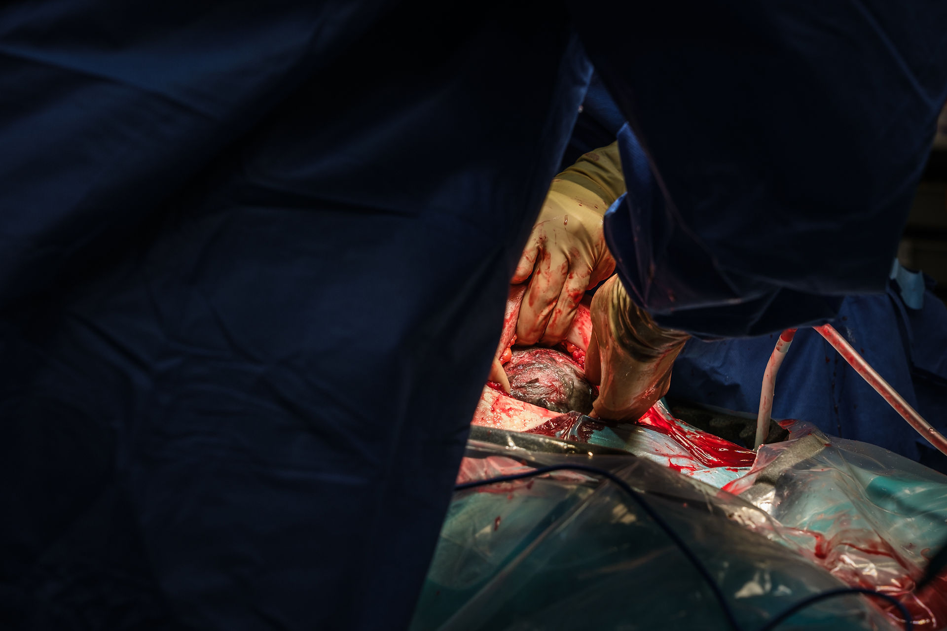 De handen van de gynaecoloog en assistent trekken de buikwand open en de haartjes van de baby worden zichtbaar tijdens een keizersnede. 