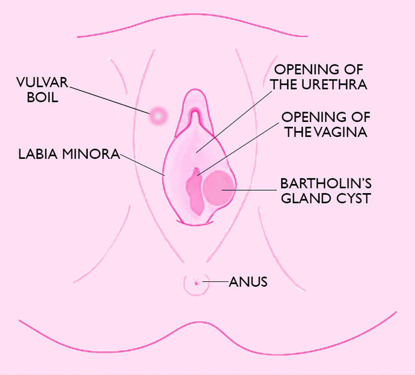 Vagina boils vs cysts