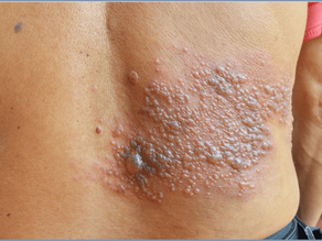 Vacinação Contra Herpes Zoster: Por Que é Tão Importante?