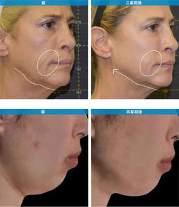 Sof wave effect - tightens skin and improves fine lines