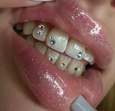 Close-up of sparkling tooth gems Rotterdam on front teeth.