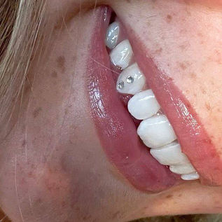 Small crystal tooth gems on a person's upper smile.