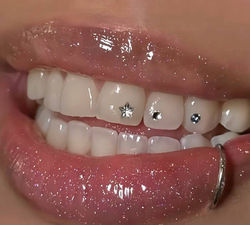 Star and round tooth gems Rotterdam on upper teeth