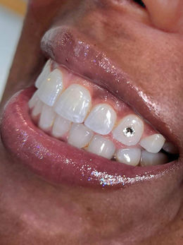 Small crystal tooth gems Rotterdam on a bright smile