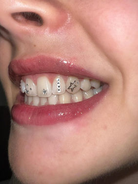 Close-up of a smile with star and gem tooth jewelry.