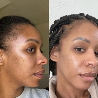 acne scars and pigmentation fading on darker skin