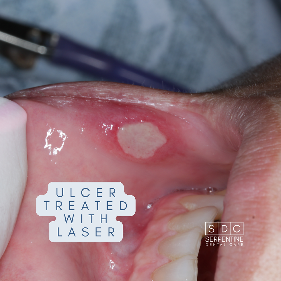 aphthous ulcer treated with laser